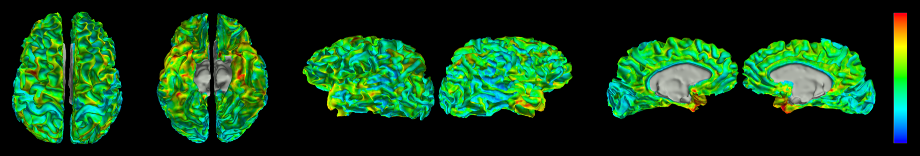 Sumaru viewing an inflated cortical surface with a statistical overlay